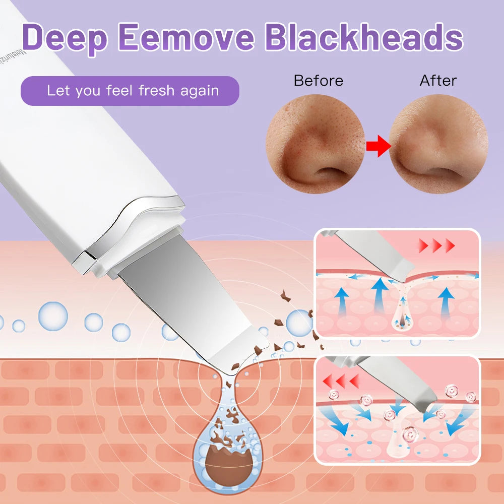 SOLVEA™ Ultrasonic Skin Scrubber